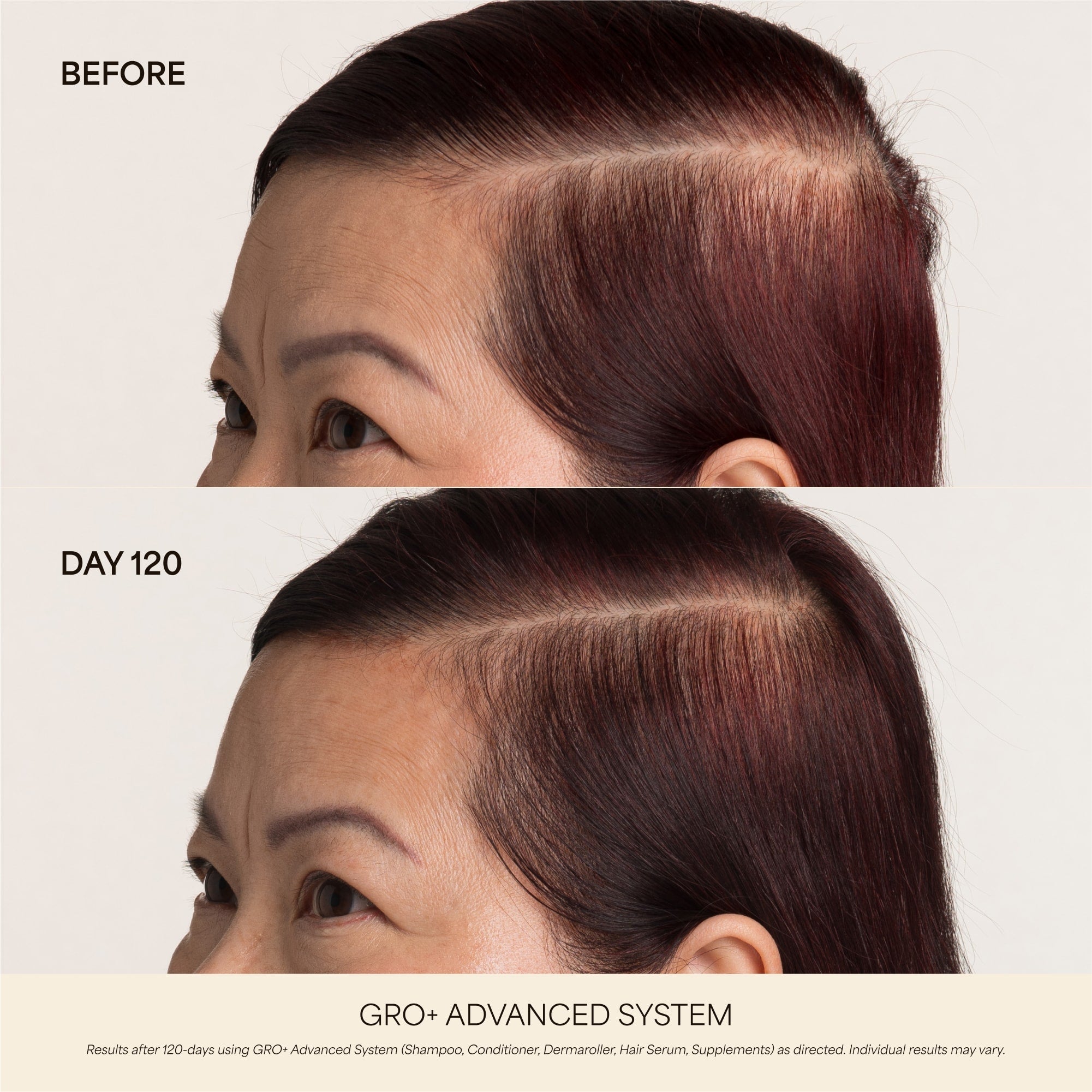GRO+ Advanced — Dermaroller Stimulant