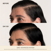 GRO+ Advanced — Dermaroller Stimulant