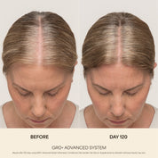 GRO+ Advanced — Dermaroller Stimulant
